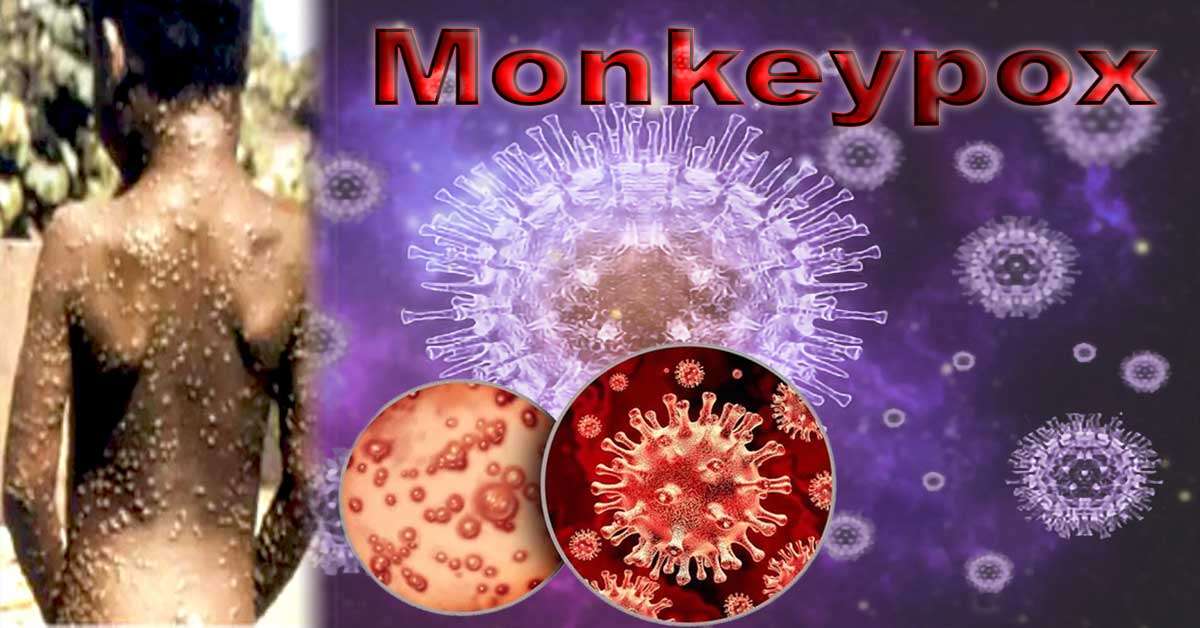 Monkeypox, cases and vaccine 2023 |mbbsbooks