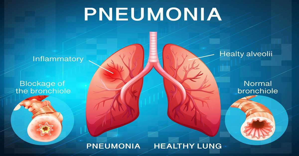 Pneumonia symptoms & Pneumonia causes 2023 | mbbsbooks