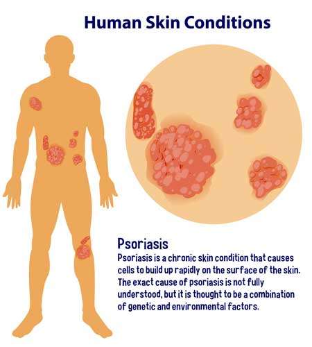Psoriasis-on-Skin