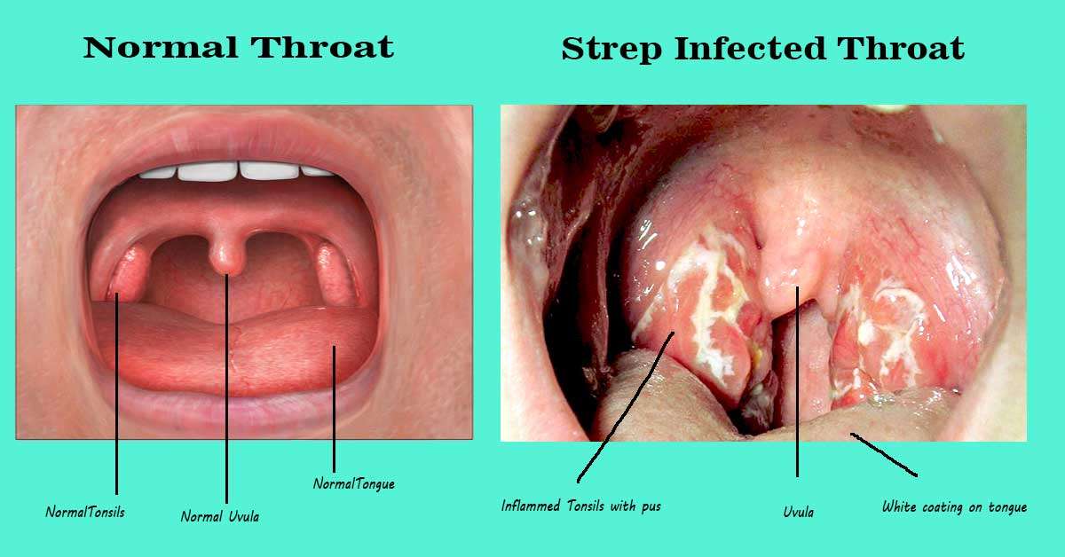 Strep Throat (2023)