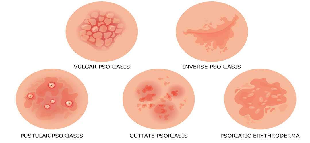 Types-of-Psoriasis