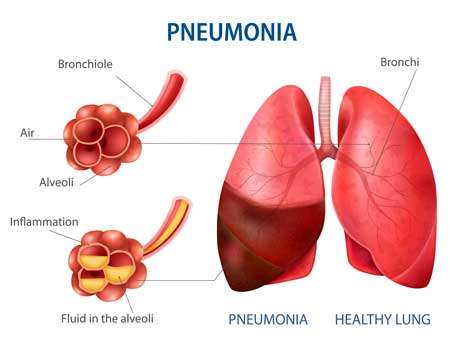 Pneumonia-affected-lung