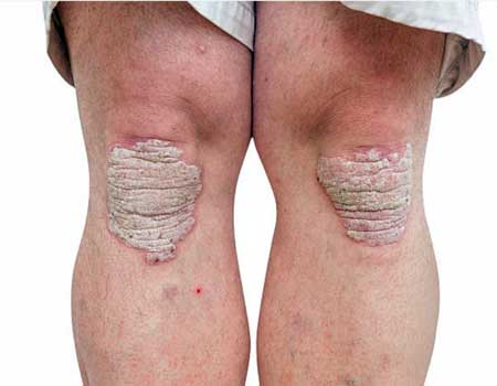 Psoriasis-on-Knee-joints