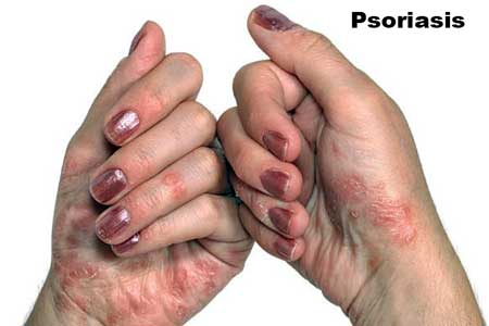 Psoriasis-on-hands
