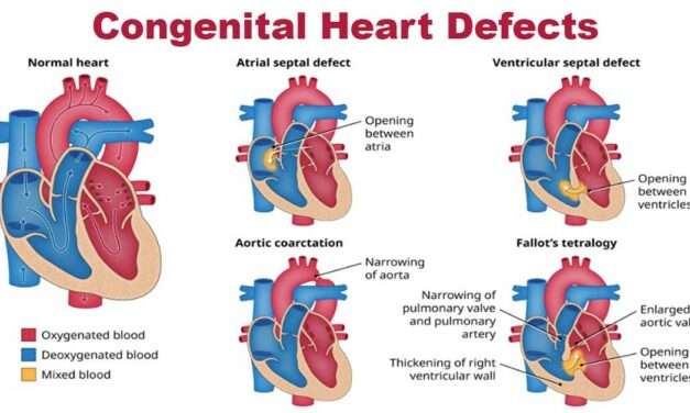 Congenital heart disease 2023
