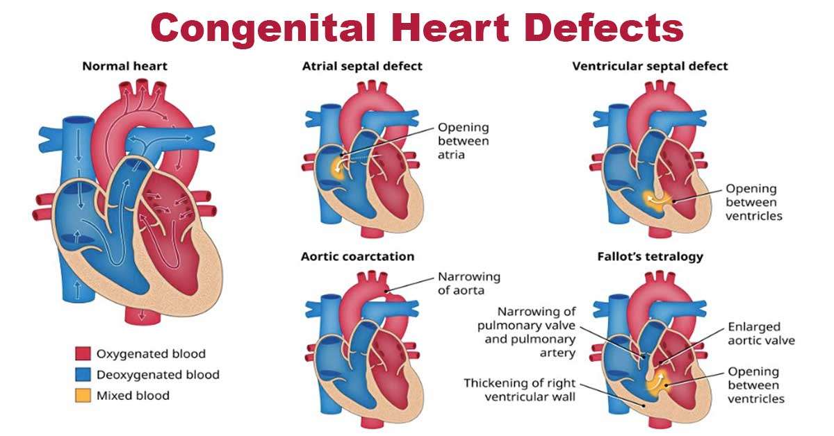 Congenital heart disease 2023